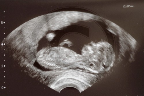 Ultraschallbild eines Foetus in der 12 Schwangerschaftswoche