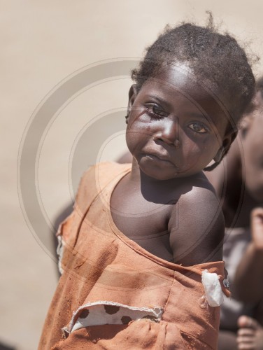 Weinendes Kind im Fluechtlingslager Sevare in Mopti in Mali